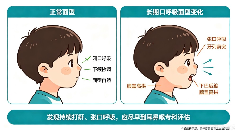 腺样体肥大科普 (2).jpg