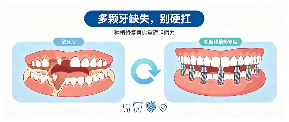 多颗牙缺失别硬扛，多颗种植重建咀嚼力